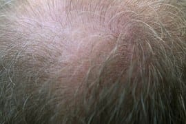 bald hair
