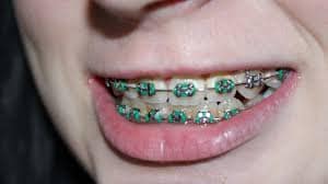 teeth with braces 